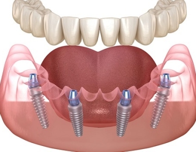 Địa chỉ trồng răng Implant All On 4 uy tín tại quận 3: Nha khoa SV 