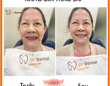 Khách hàng hài lòng sau khi làm răng giả tháo lắp tại SV Dental