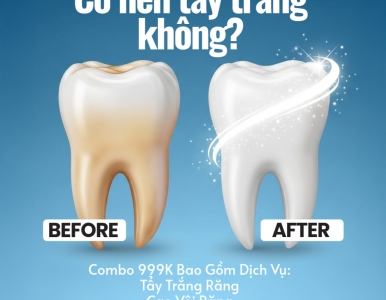 Tẩy Trắng Răng Combo 999K – Giải Pháp Cho Nụ Cười Trắng Sáng Tự Nhiên