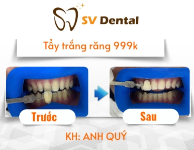Combo Tẩy Trắng Răng 999K – Sở Hữu Nụ Cười Trắng Sáng, Tự Tin Tỏa Sáng!