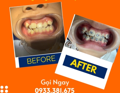 🦷 Niềng Răng Giá Rẻ TPHCM – Chỉ Từ 999K/Tháng Tại SV Dental