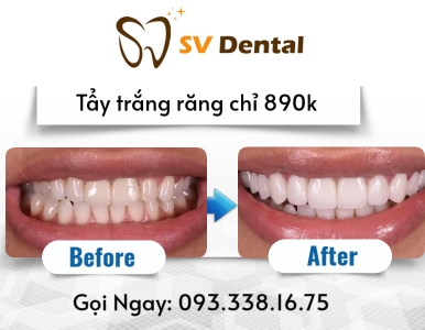 TẨY TRẮNG RĂNG CHỈ 890K – TRẮNG SÁNG NGAY SAU 1 LẦN TẠI SV DENTAL