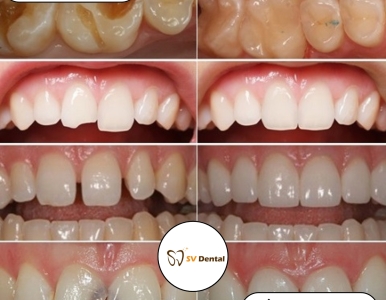 Trám Răng Thẩm Mỹ – Giải Pháp Phục Hồi Răng Hiệu Quả, An Toàn và Tự Nhiên