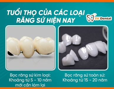 Bọc Răng Sứ Bao Lâu Thì Phải Làm Lại? [Giải Đáp Chi Tiết]