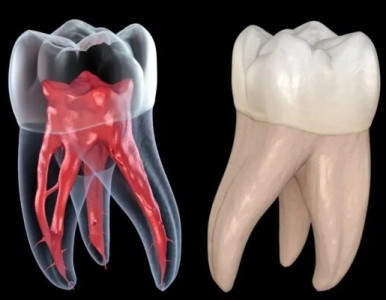 Điều trị tủy phục hình răng sứ diễn ra như thế nào?