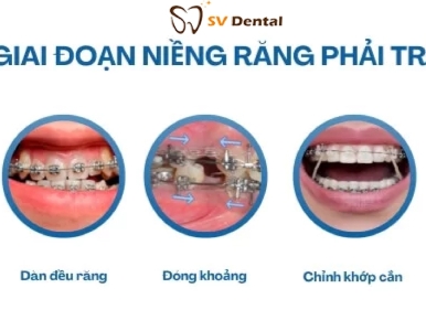 5 Giai Đoạn Niềng Răng Bạn Cần Biết – Hành Trình Sở Hữu Nụ Cười Hoàn Hảo