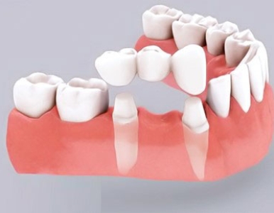 Các loại cầu răng sứ phổ biến hiện nay: Nha khoa SV quận 3 