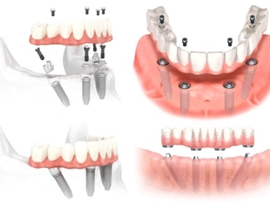 Trồng răng implant ở đâu tốt tại TP Hồ Chí Minh? Nha khoa SV quận 3
