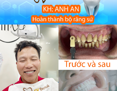 ⭐ Bọc răng sứ — Bí quyết giúp anh An tự tin khoe nụ cười mới tại SV Dental