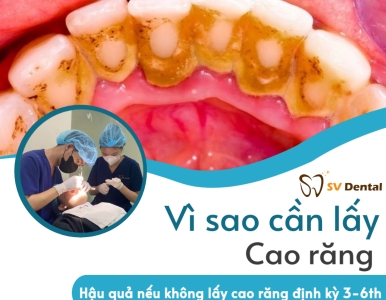Tại sao cần lấy cao răng định kỳ? Hậu quả nếu không lấy?