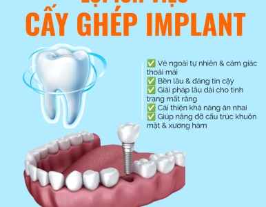 Lợi Ích Vượt Trội Của Cấy Ghép Implant – Giải Pháp Phục Hồi Răng Mất Hiện Đại