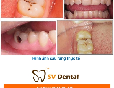 Hình Ảnh Sâu Răng Thực Tế – Dấu Hiệu Không Thể Bỏ Qua!