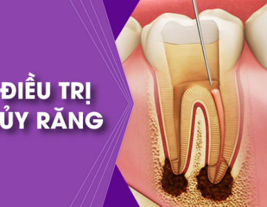 Dịch vụ điều trị tủy răng - Nha khoa SV quận 3