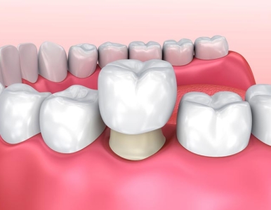 Nha khoa trồng răng sứ tại quận 3, TP Hồ Chí Minh- Nha khoa SV
