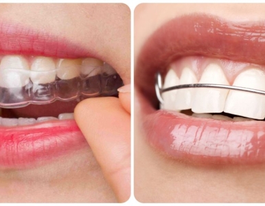 Hàm duy trì sau khi niềng răng là gì? Nha khoa SV quận 3