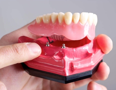 Hàm tháo lắp trên Implant là gì? Nha khoa SV quận 3 