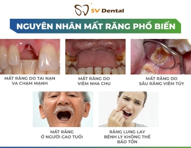 Nguyên Nhân Gây Mất Răng Phổ Biến – Cảnh Báo Từ SV Dental