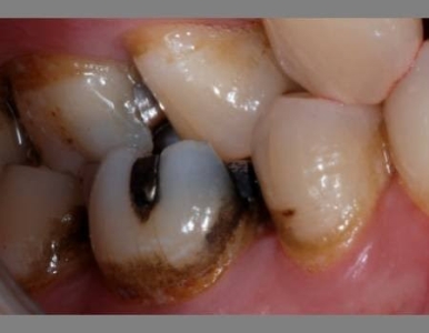 Thức Ăn Luôn Mắc Vào Một Kẽ Răng: Đừng Bỏ Qua Dấu Hiệu Này