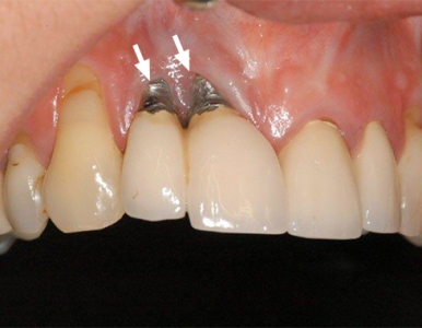 Trụ implant bị đào thải: Dấu hiệu và cách khắc phục