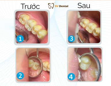 Xử Lý 5 Răng Sâu Hiệu Quả – Khách Hàng Hài Lòng Tại SV Dental
