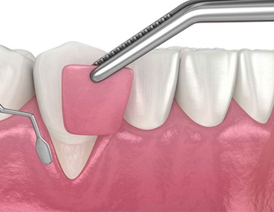 Nạo túi nha chu là gì? Nha khoa SV đường Cao Thắng quận 3