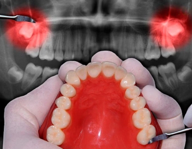 Nhổ răng khôn – Có thật sự đáng sợ như bạn nghĩ?