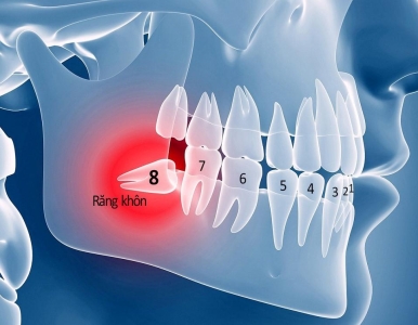 Khi Nào Thì Cần Nhổ Răng Khôn? – Giải Đáp Từ Bác Sĩ Răng Hàm Mặt