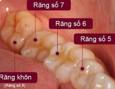 Có nên nhổ răng số 7 hay không? Nha khoa SV quận 3 Cao Thắng