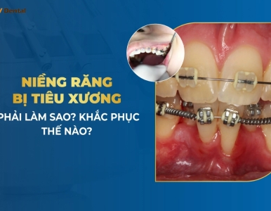 Niềng Răng Bị Tiêu Xương: Nguyên Nhân, Cách Khắc Phục và Phòng Ngừa