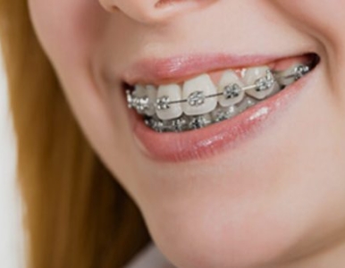 Niềng răng hô nhẹ tại Nha khoa SV quận 3 đường Cao Thắng 