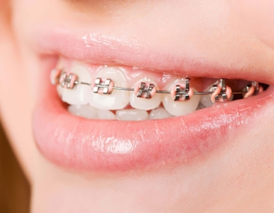 Niềng răng mắc cài kim loại tại quận 3: Chi phí, Ưu và nhược điểm