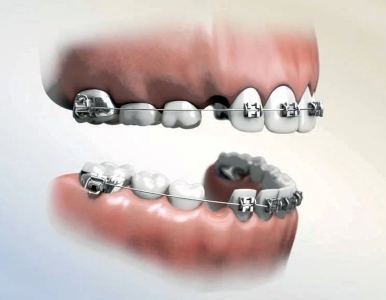 🦷 Niềng răng có nhổ răng được không? Giải đáp chi tiết từ bác sĩ