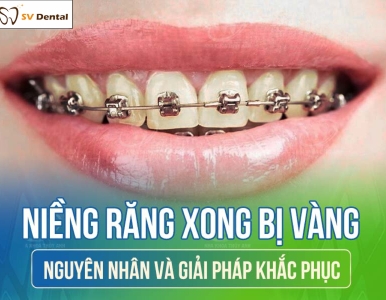 🦷 Niềng Răng Xong Bị Vàng – Nguyên Nhân Và Giải Pháp Khắc Phục Hiệu Quả