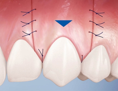Ghép nướu là gì? Các phương pháp ghép nướu: Nha khoa SV quận 3