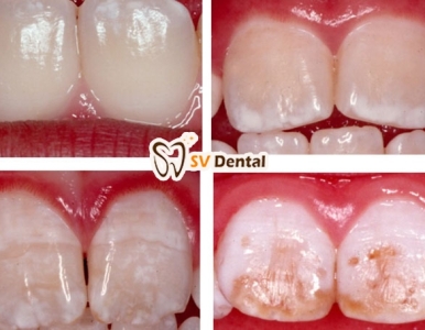 🦷 Răng Bị Đốm Trắng Là Gì? Nguyên Nhân & Cách Xử Lý Hiệu Quả