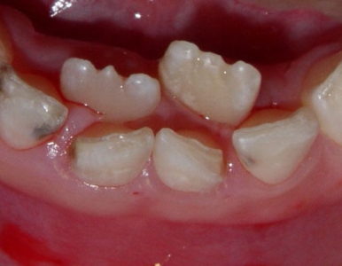 Răng mọc lẫy ở trẻ: Nguyên nhân và cách khắc phục