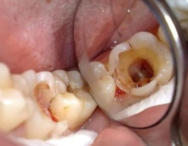 Răng Sâu Bị Bể Có Trám Được Không? Khi Nào Cần Chữa Tủy?