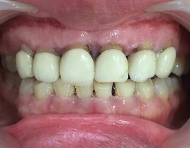 Răng sứ bị hở và cách khắc phục hiệu quả