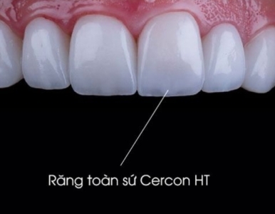 Trồng răng toàn sứ Cercon HT: Ưu điểm nổi bât và chi phí 