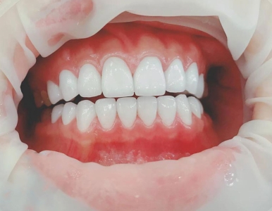 Răng sứ Lava Esthetic là gì?  Nha khoa SV đường Cao Thắng, Q3