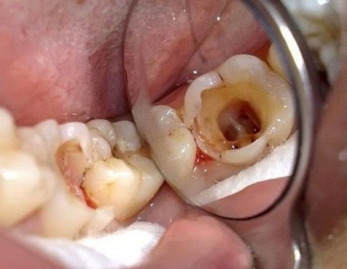 Nguyên nhân và cách điều trị sâu răng nặng: Nha khoa quận 3 