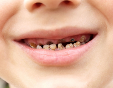 Sâu răng ở trẻ em: Nguyên nhân và cách điều trị 