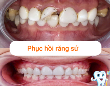 Phục Hồi Răng Sứ – Giải Pháp Cứu Cánh Cho Nụ Cười Xuống Cấp