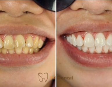 Tẩy Trắng Răng Kết Hợp Cạo Vôi Răng Chỉ 990K – Giải Pháp Cho Nụ Cười Sáng Khỏe