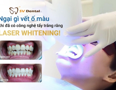 TẨY TRẮNG RĂNG BẰNG LASER WHITENING – GIẢI PHÁP CHO NỤ CƯỜI TRẮNG SÁNG