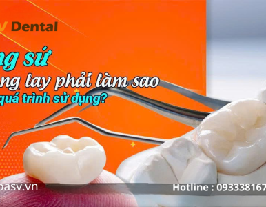 Răng sứ bị lung lay phải làm sao? Nguyên nhân – cách xử lý – phòng tránh hiệu quả tại Nha Khoa SV 