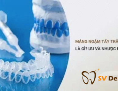 Máng tẩy trắng răng là gì? Ưu điểm, nhược điểm và hướng dẫn sử dụng an toàn tại Nha Khoa SV