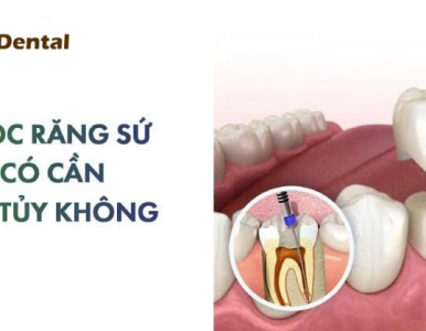 Bọc Răng Sứ Có Cần Lấy Tủy Không? Khi Nào Bắt Buộc Lấy Tủy Tại Nha Khoa SV Quận 3