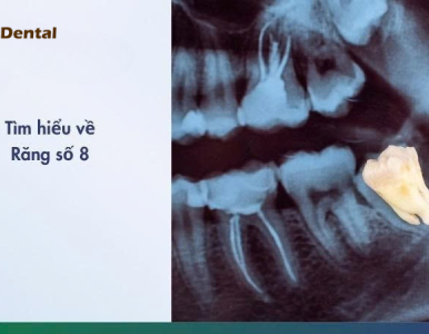 Răng số 8 là gì? Dấu hiệu và cách xử lý khi mọc răng khôn tại NHA KHOA SV 