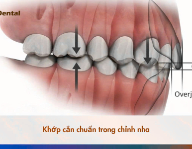 Khớp Cắn Chuẩn Là Gì? Cách Xác Định Và Điều Chỉnh Chuẩn Nhất Tại Nha Khoa SV